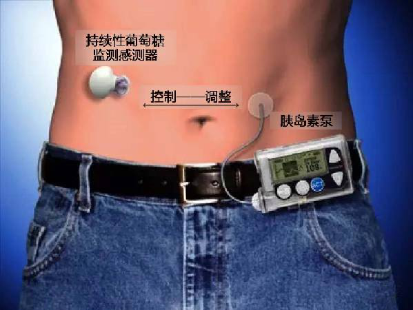 胰島素泵(insulin pump)示意圖 胰島素泵(insulin pump)示意圖
